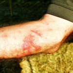man with skin burns from giant hogweed