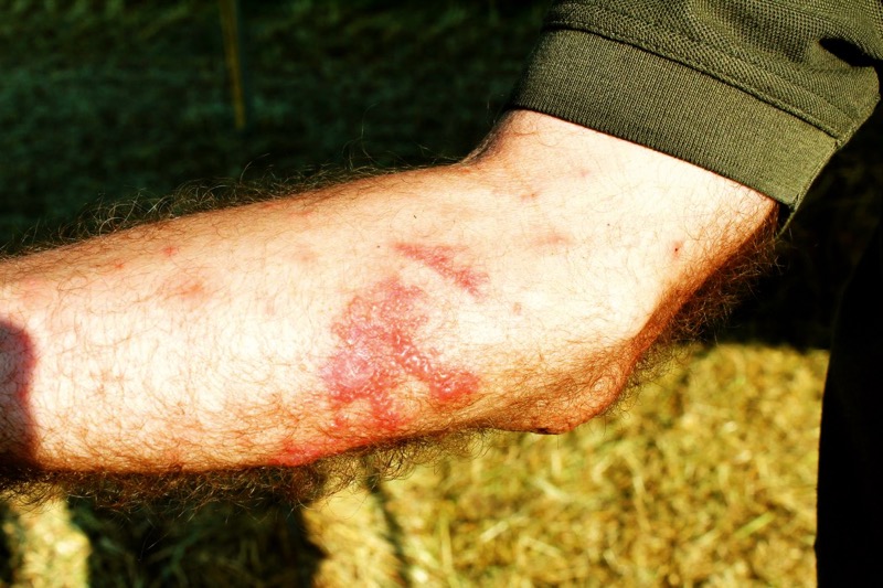 man with skin burns from giant hogweed