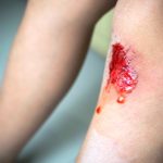 Child with bleeding knee wound