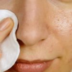 Though often seen as the plight of the young, about 12 per cent of people have acne flare-ups later in life.