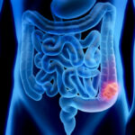 Guide Health: Colonoscopies – A really good thing!