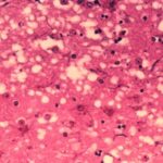 A microscope-level view of damaged brain tissue from a cow infected with BSE. (USDA photo via U.S. Food and Drug Administration)
